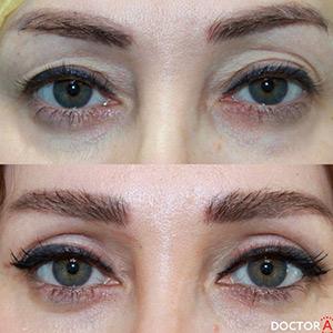 Блефаропластика