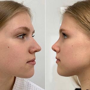 Риносептопластика