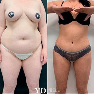 Классическая абдоминопластика