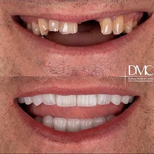 Имплантация зубов с установкой коронок