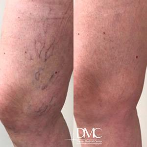 Склеротерапия вен